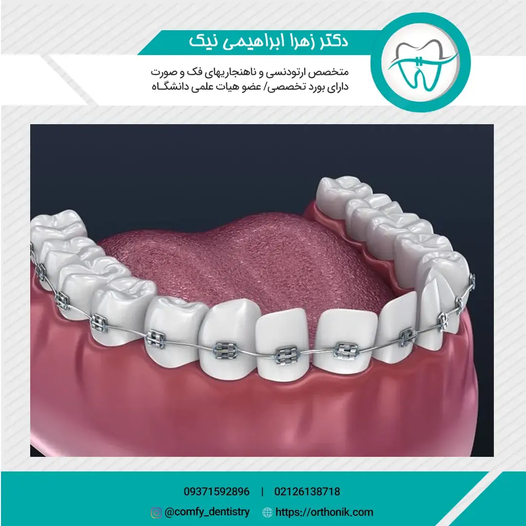 ارتودنسی-یک-دندان-کج